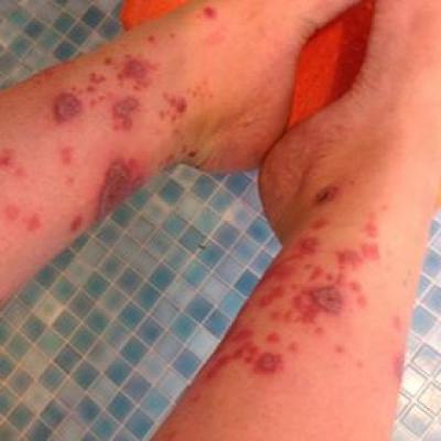 Vasculitis Before