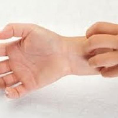 Eczema