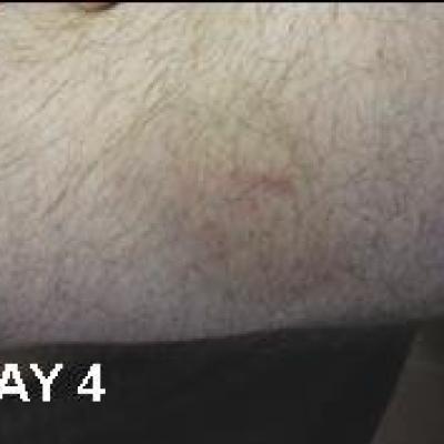 Horsebite day 4