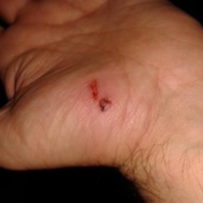 Palm injury